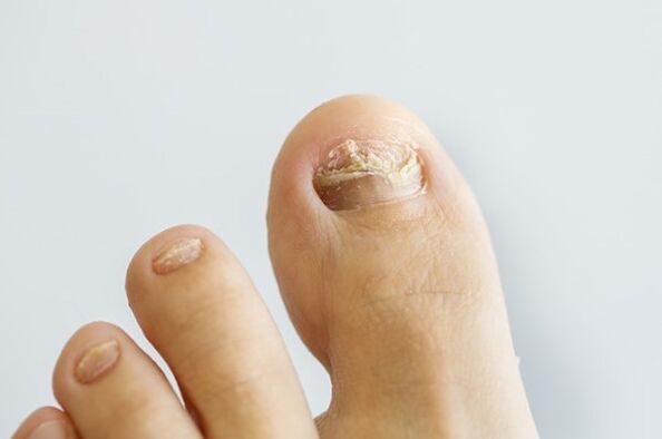 Nail fungus