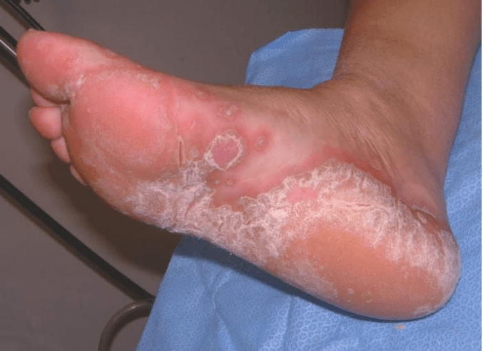 Determine the foot mushroom