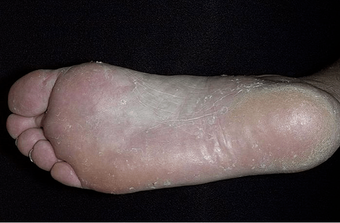 The foot mushroom