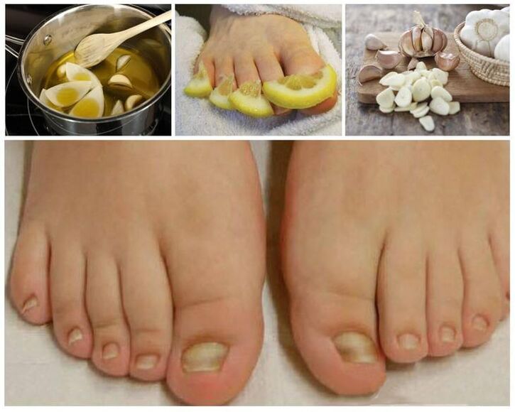 Nail fungus