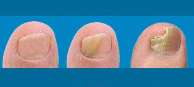 Nail mushroom development process