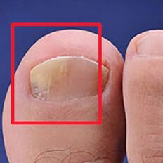 Mycosis or fungus of the nails