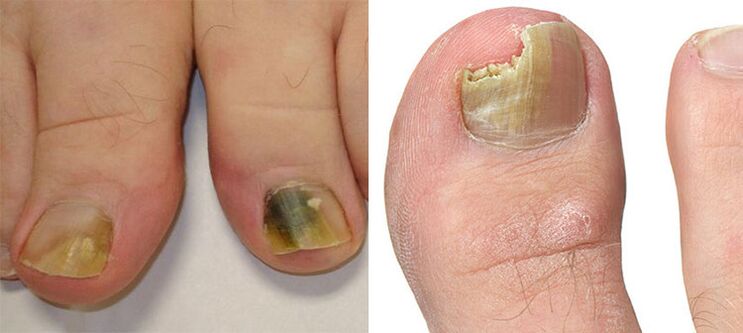 Onychomicosis - Destruction of nails with a mushroom