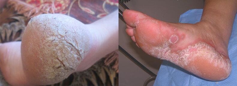 The feet affected by the mushroom