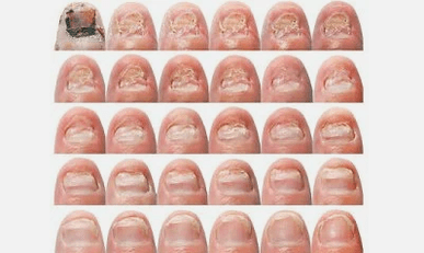 What the nail fungus is waiting for