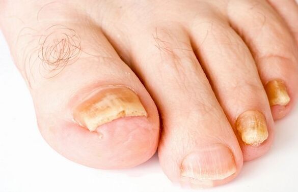 Nail fungus