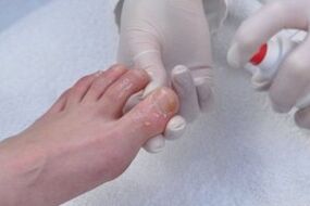 treatment of fungal nail