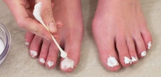 Toenail fungus treatment with ointment
