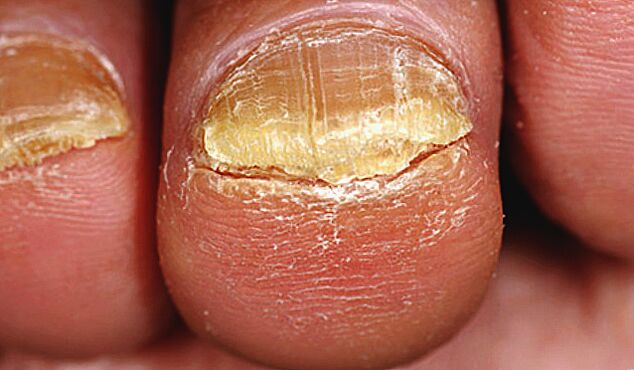 advanced fungus on the toenails