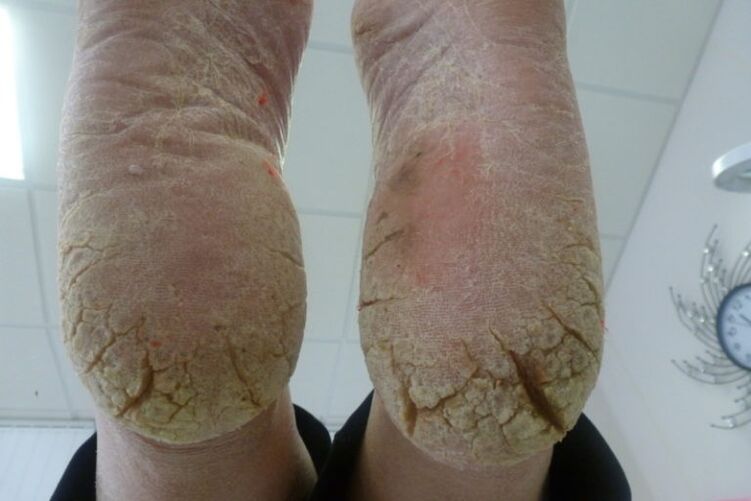 Deep cracks in the skin of the feet with advanced forms of fungus