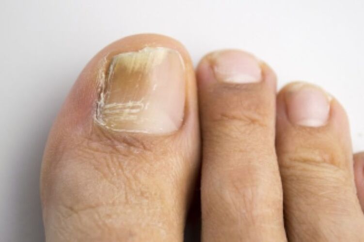 Fungal infection on toenails