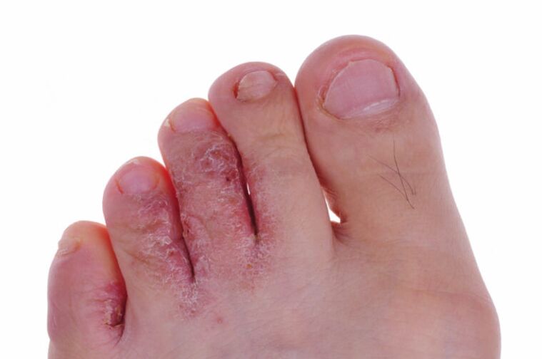 Red, cracked skin between the toes due to a fungal infection