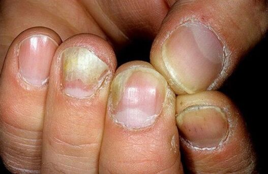 photo of nail fungus