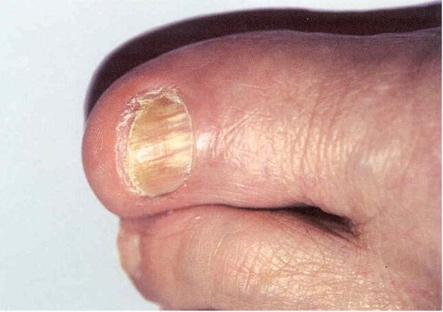 Onychomycosis - fungal infection of the toenails