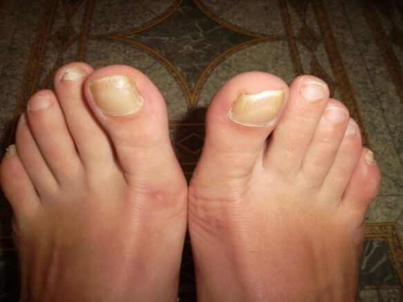 Fungal infection of the big toe nails