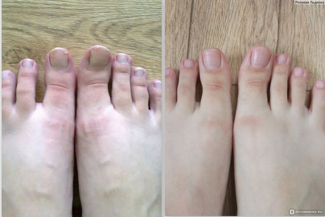 before and after treatment of mushrooms with Fungostop Plus cream